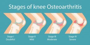 osteoarthritida-gonatos